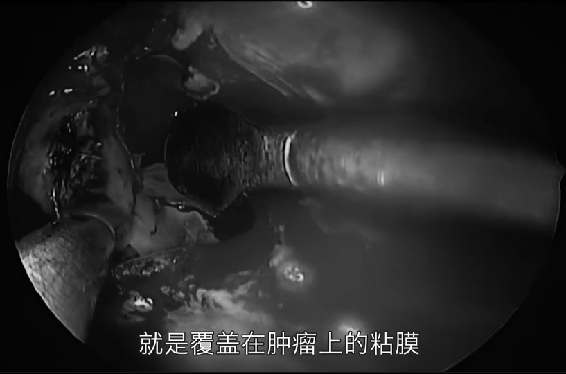 在突起的粘膜上開了個(gè)口，就是覆蓋在腫瘤上的粘膜