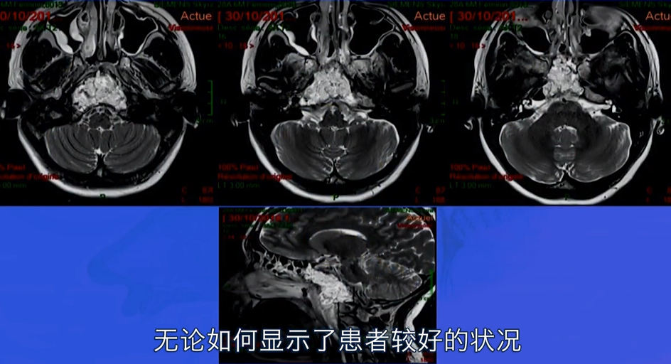 不開顱從鼻孔1cm切口竟就可以取出較大腦瘤