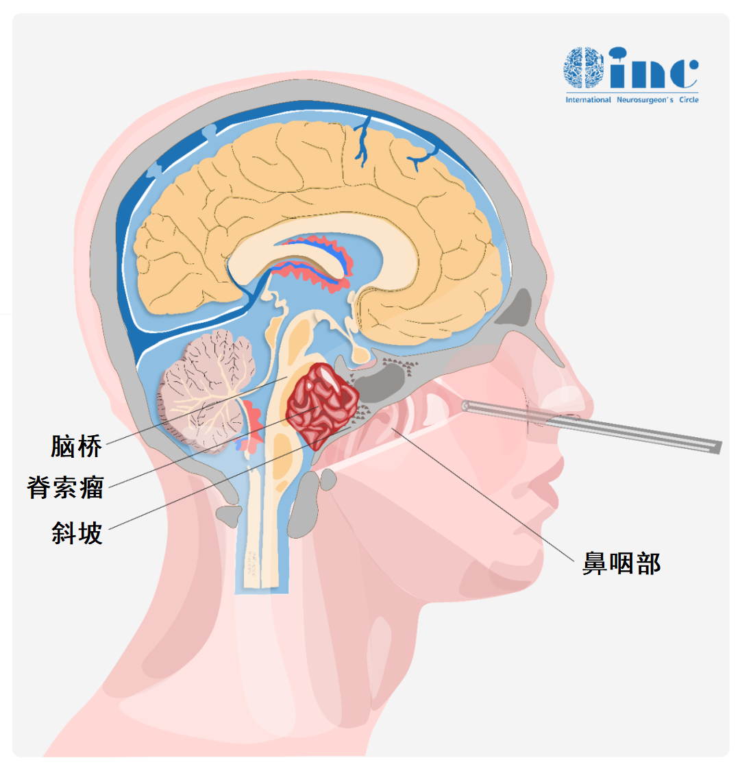 圖示為內(nèi)鏡經(jīng)鼻入路切除脊索瘤
