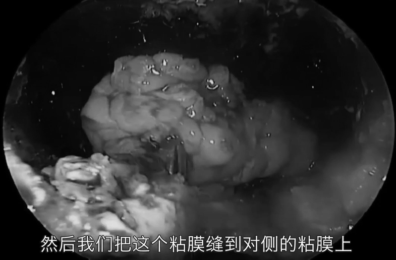 不開顱從鼻孔1cm切口竟就可以取出較大腦瘤