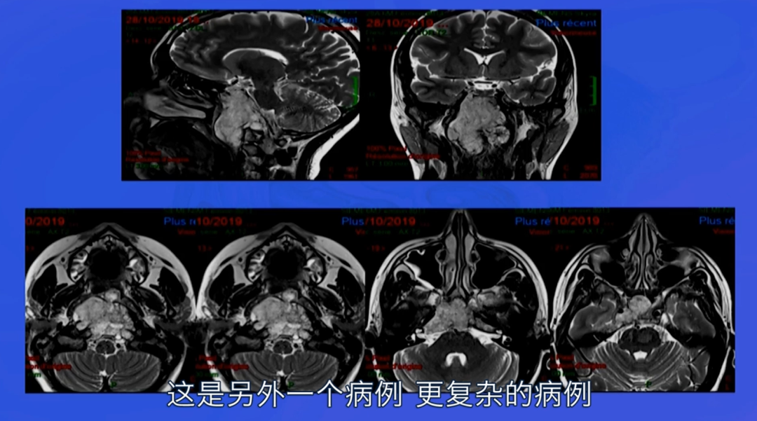 不開顱就把大手術(shù)做了，從鼻子切腦子里的腫瘤