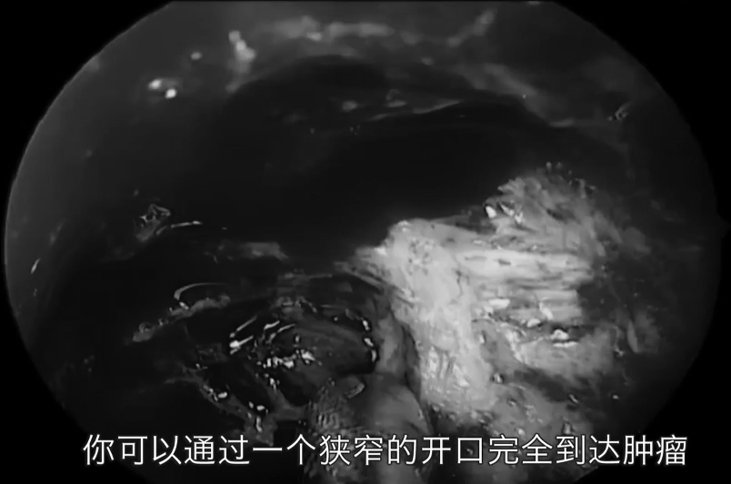 可以通過一個(gè)狹窄的開口完全到達(dá)腫瘤
