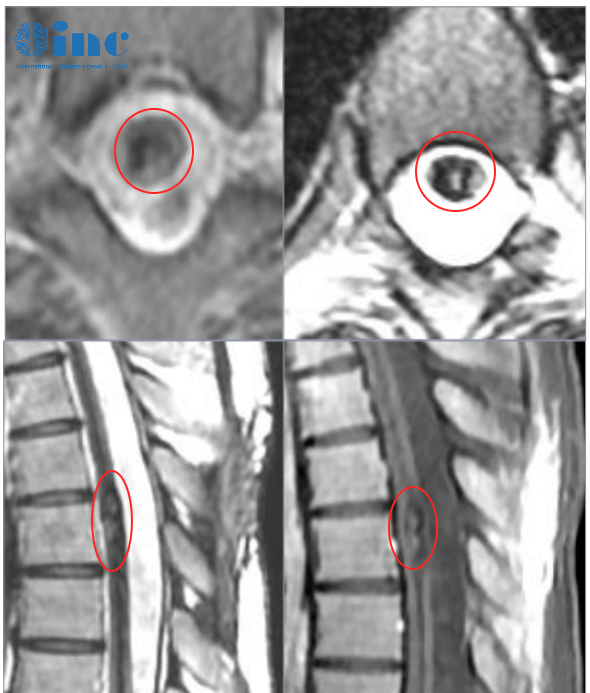 脊髓腫瘤手術(shù)——MRI