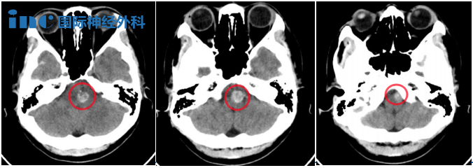 腦干海綿狀血管瘤案例——CT