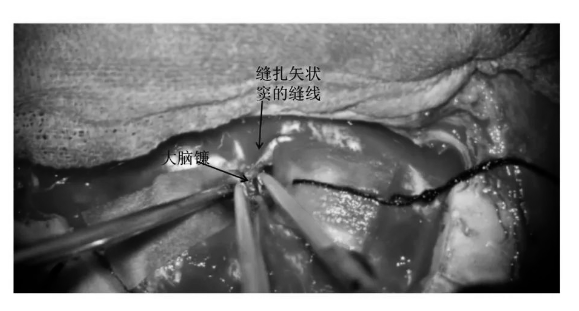 縫扎矢狀竇后剪開大腦鐮