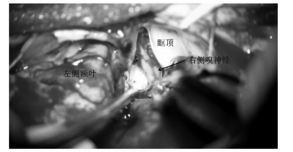 充分游離、松解右側(cè)嗅神經(jīng)