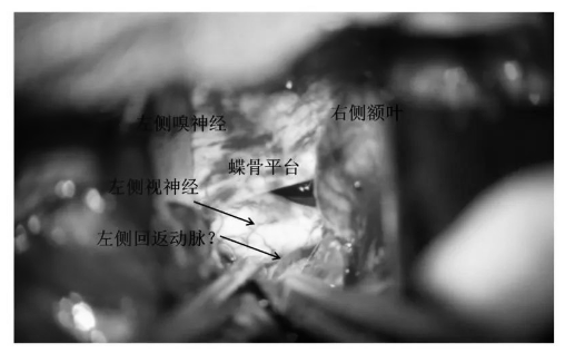 繼續(xù)往后方打開前縱裂，逐步暴露視神經(jīng)