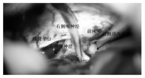充分游離后可見視神經(jīng)、嗅神經(jīng)、頸內(nèi)動脈、前床突等結(jié)構(gòu)