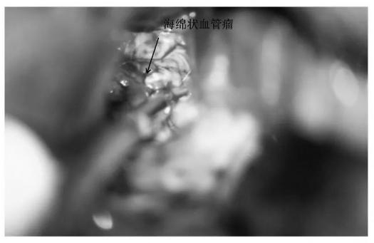 繼續(xù)沿周邊黃染的含鐵血黃素沉積帶分離腫瘤（好的操作+細致的雙較）
