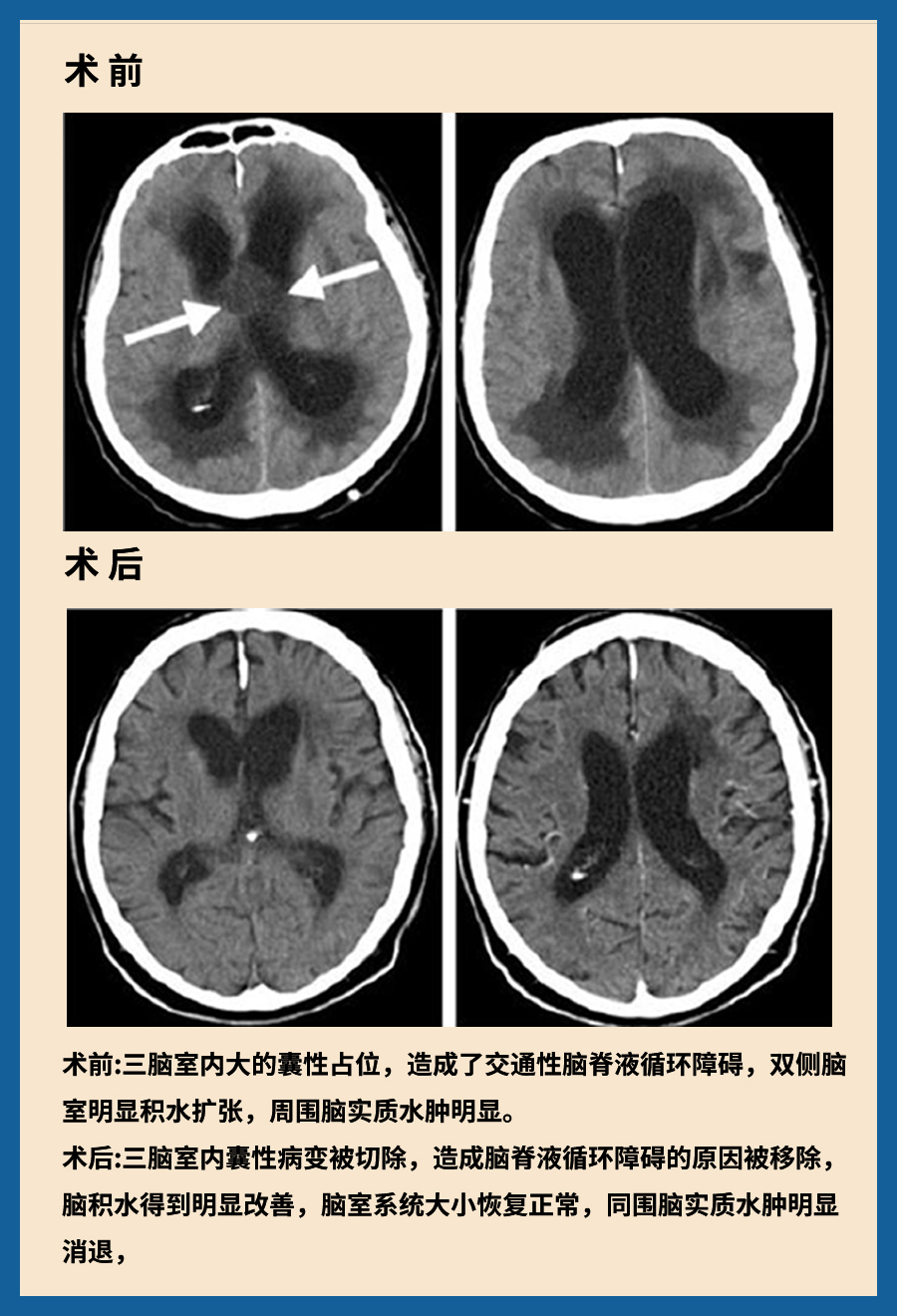 顱咽管瘤治療案例