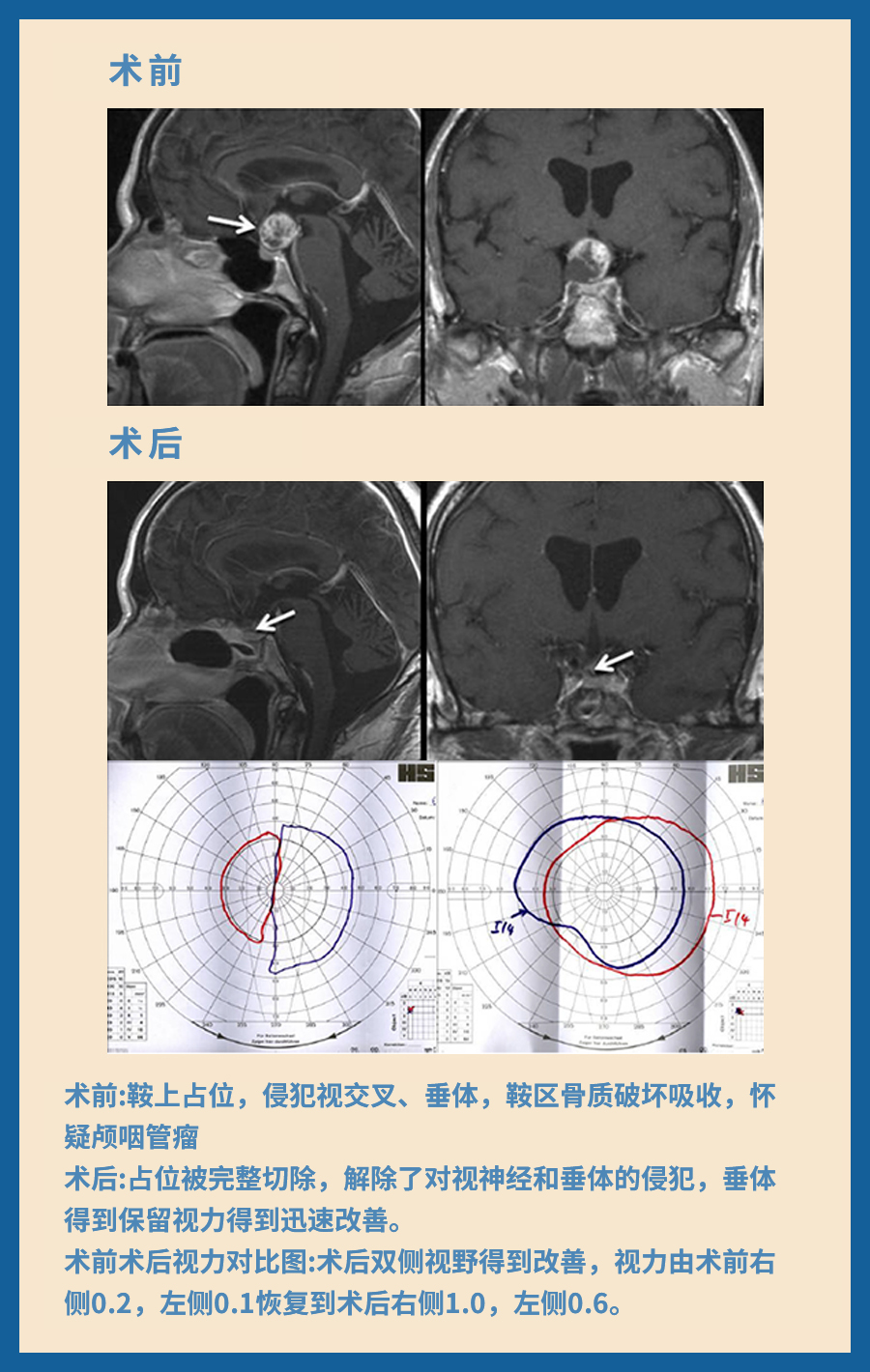 顱咽管瘤治療案例