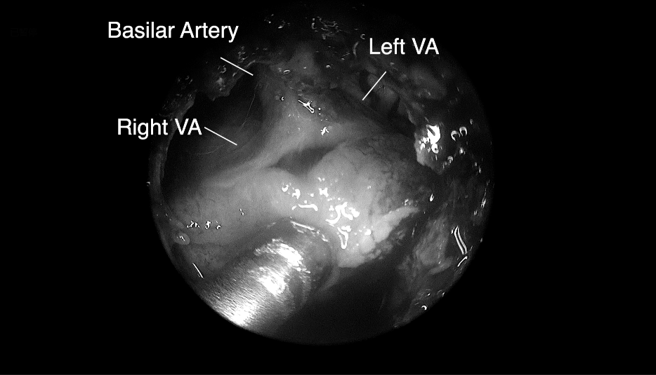 將腫瘤分離出來——Basilar Artery，基底動(dòng)脈;Left VA，左側(cè)椎動(dòng)脈; Right VA，右側(cè)椎動(dòng)脈;