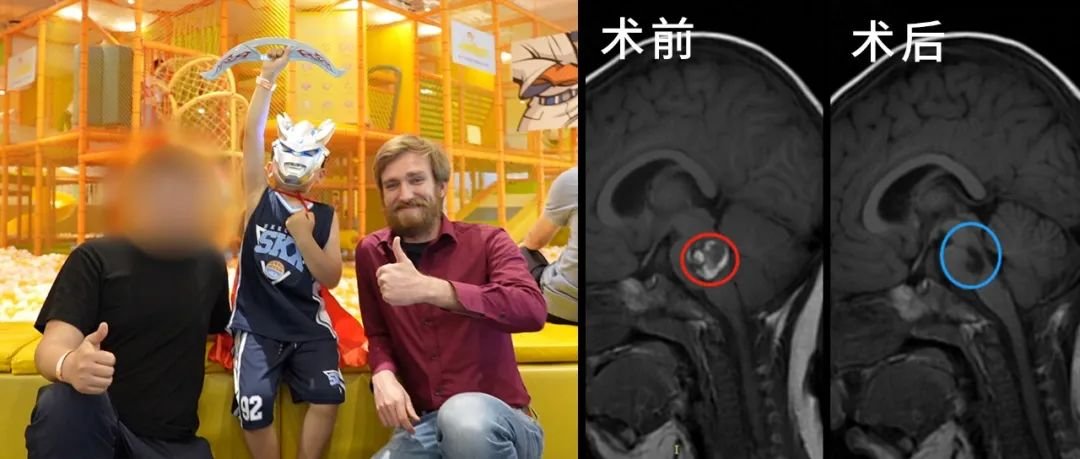 腦干海綿狀血管瘤案例