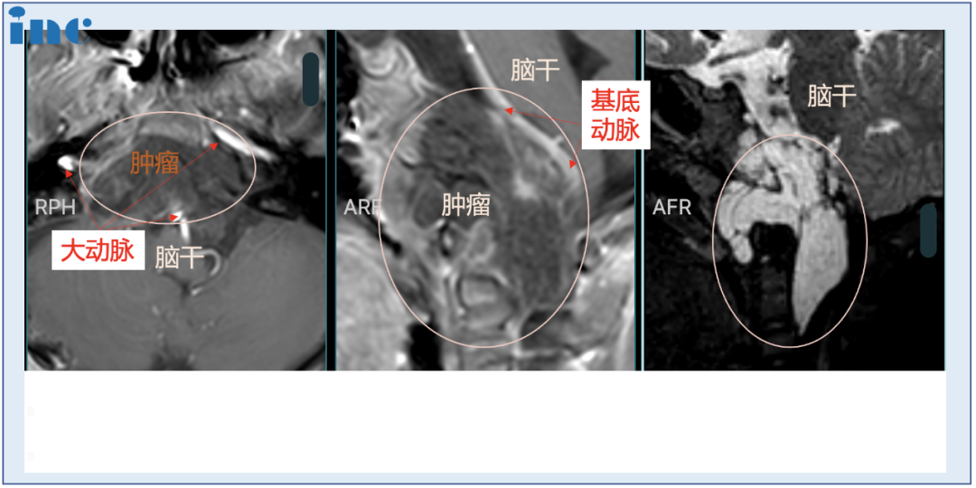 6歲男孩較大脊索瘤，單鼻孔8mm切口，不開(kāi)顱成功手術(shù)