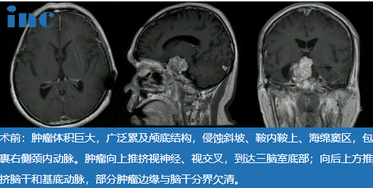 48歲較大脊索瘤復(fù)發(fā)患者，“雙鏡聯(lián)合”中國(guó)示范手術(shù)