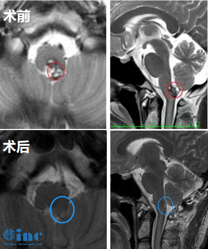 19歲男孩腦干-延髓海綿狀血管瘤