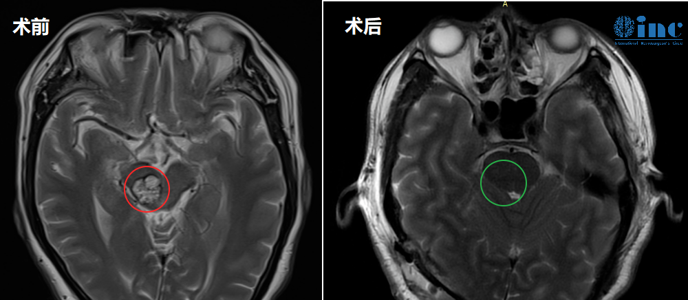 47歲男性-腦干中腦海綿狀血管瘤
