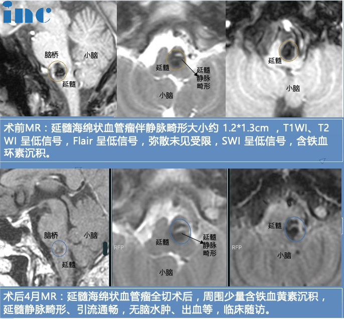 32歲男性-腦干延髓海綿狀血管瘤