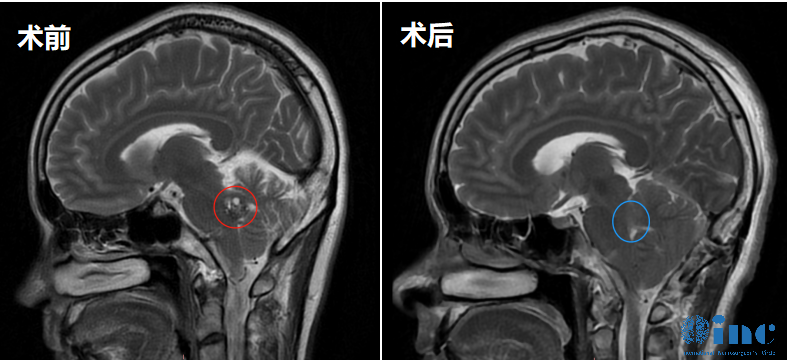 35歲女性-腦干橋腦海綿狀血管瘤