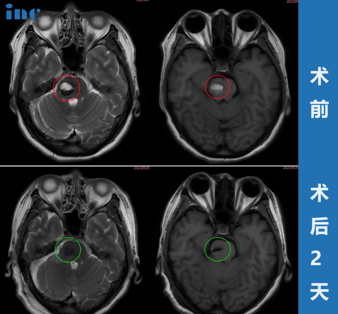 52歲女性?腦干-腦橋海綿狀血管瘤
