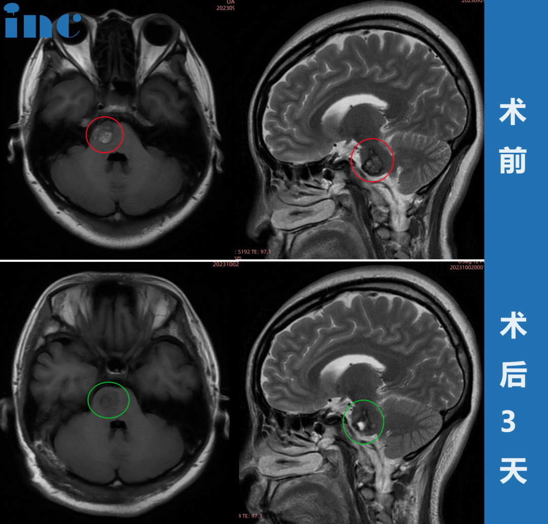 37歲女士?腦干-腦橋海綿狀血管瘤