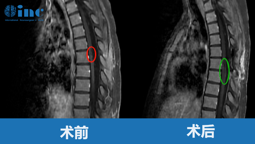 20歲女性-胸髓髓內(nèi)海綿狀血管瘤