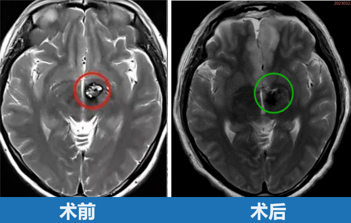 30歲女性-丘腦海綿狀血管瘤