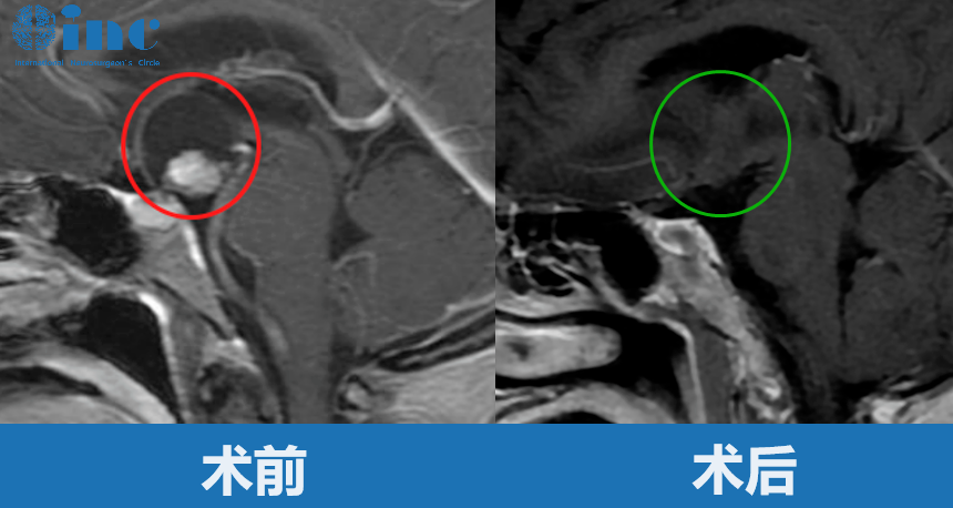 80歲女性-顱咽管瘤