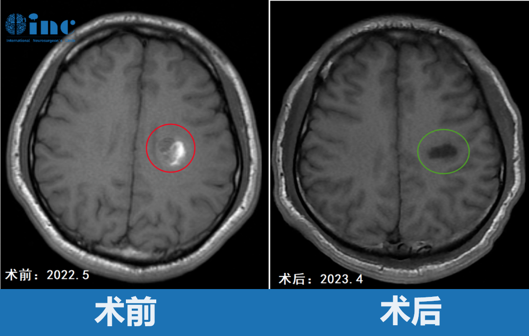 23歲男性-半卵圓中心海綿狀血管瘤
