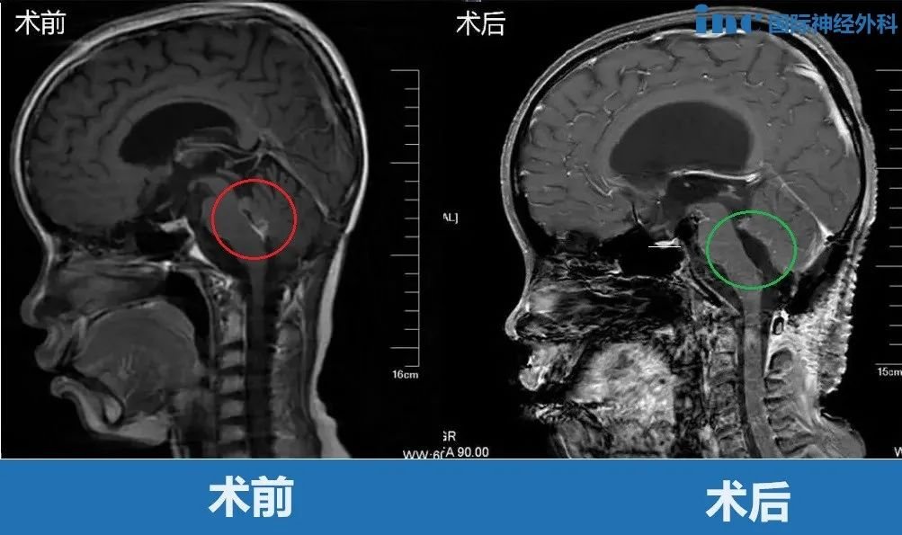 11歲男孩-四腦室腫瘤