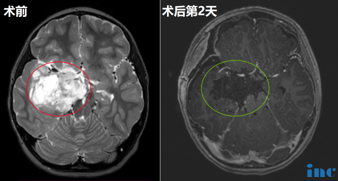 6歲女孩-顳葉島葉膠質(zhì)瘤