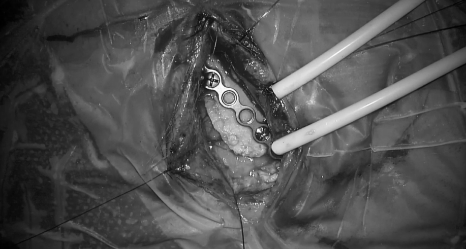 使用腹部脂肪進(jìn)行術(shù)野填充（避免使用人工耗材-具有炎性等風(fēng)險(xiǎn)，可致眼部不適影響生活質(zhì)量）