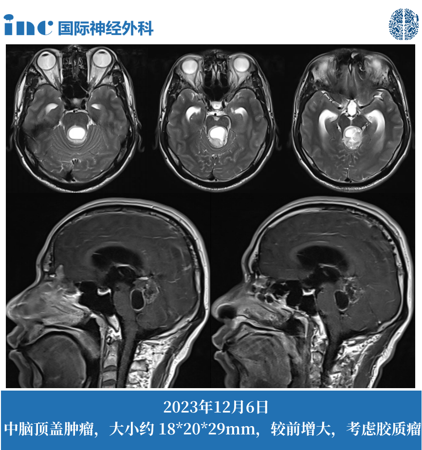 36歲男性--四疊體區(qū)占位；梗阻性腦積水影像