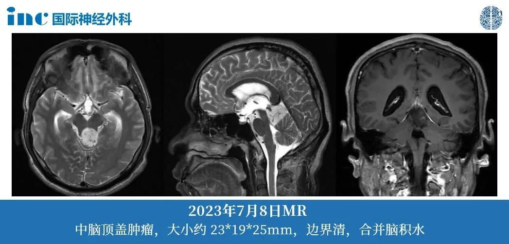 36歲男性--四疊體區(qū)占位；梗阻性腦積水