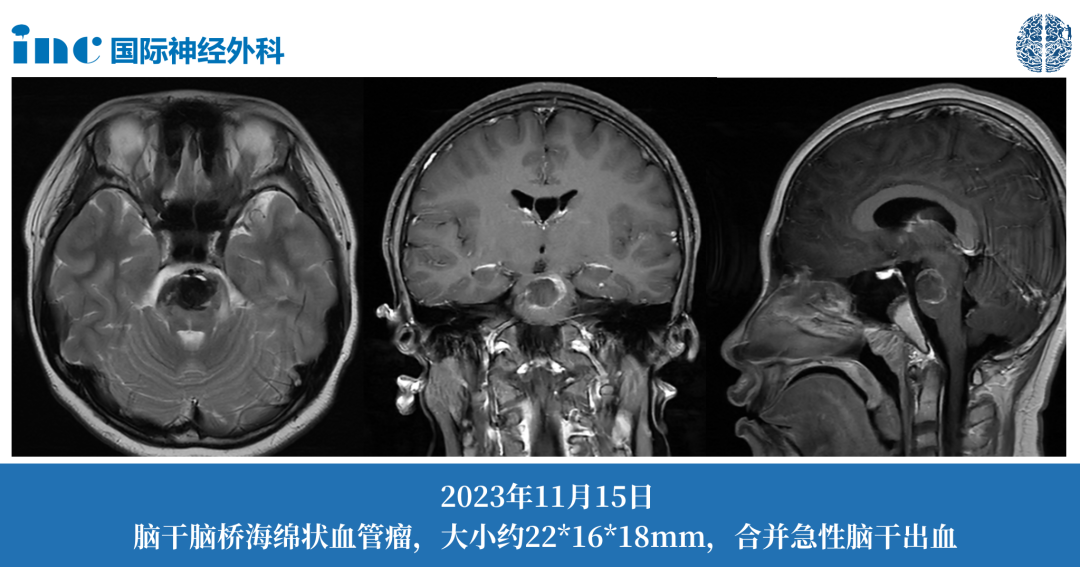 11歲男孩--腦干海綿狀血管瘤