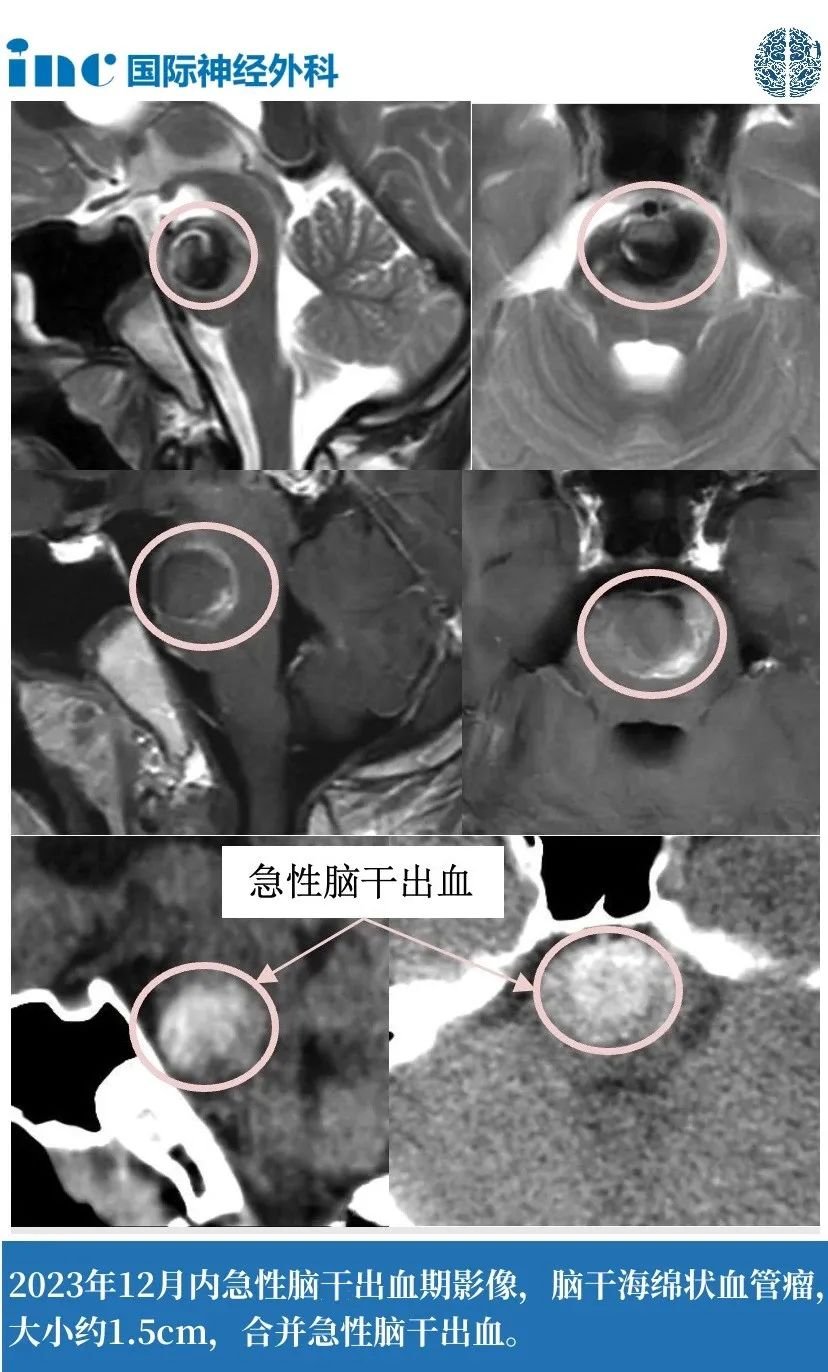 11歲男孩--腦干海綿狀血管瘤案例