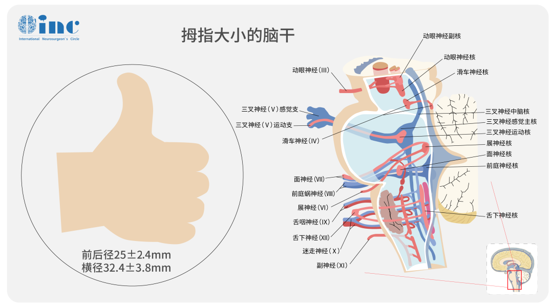 腦干海綿狀血管瘤