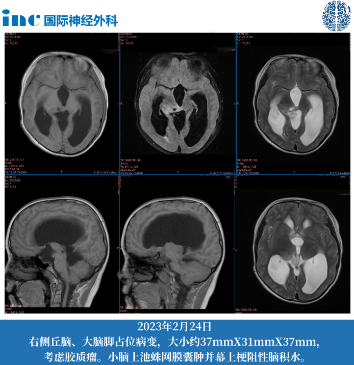11歲男孩--中腦-丘腦占位；梗阻性腦積水（側(cè)腦室腹腔分流術(shù)后）