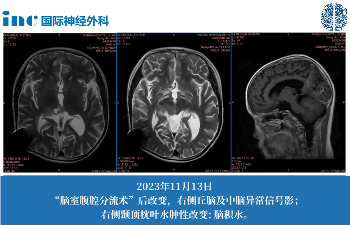 11歲男孩--中腦-丘腦占位；梗阻性腦積水（側(cè)腦室腹腔分流術(shù)后）