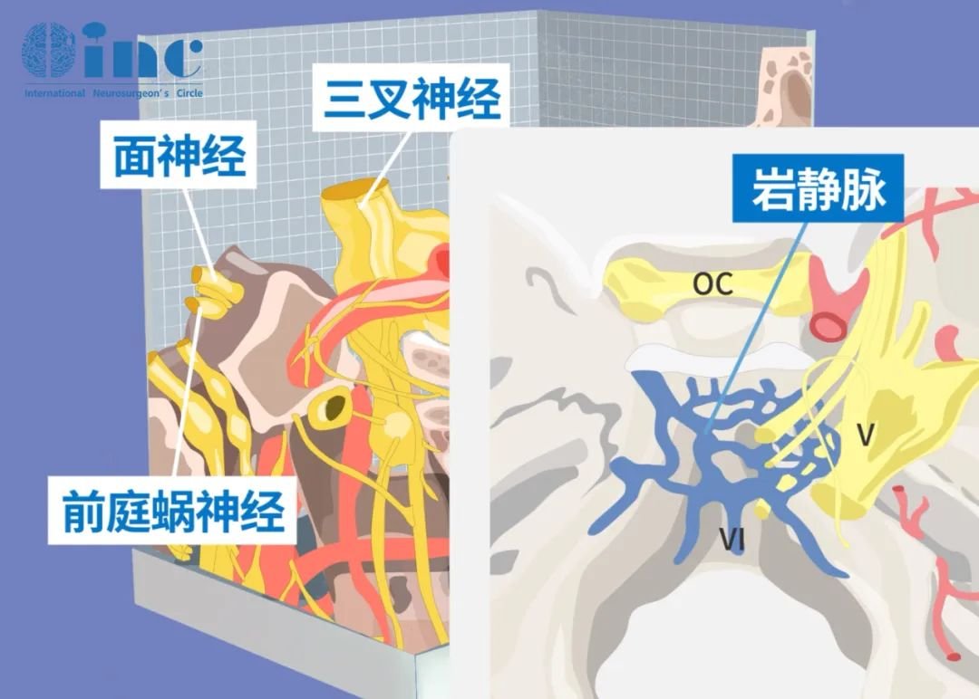 CPA橋小腦角區(qū)