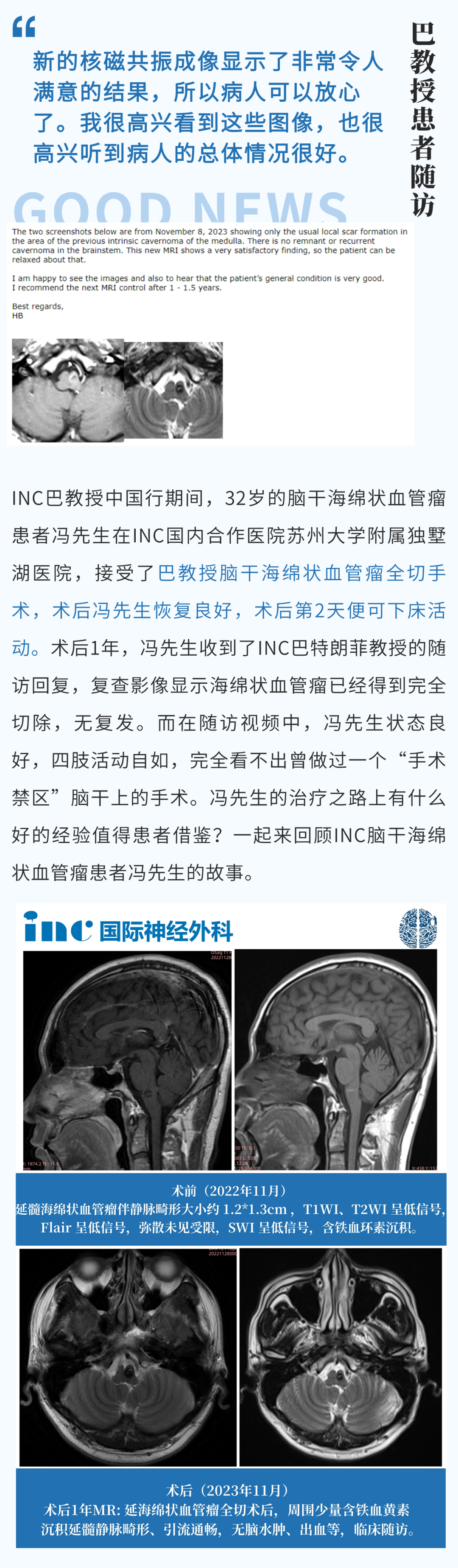 32歲腦干-延髓海綿狀血管瘤患者