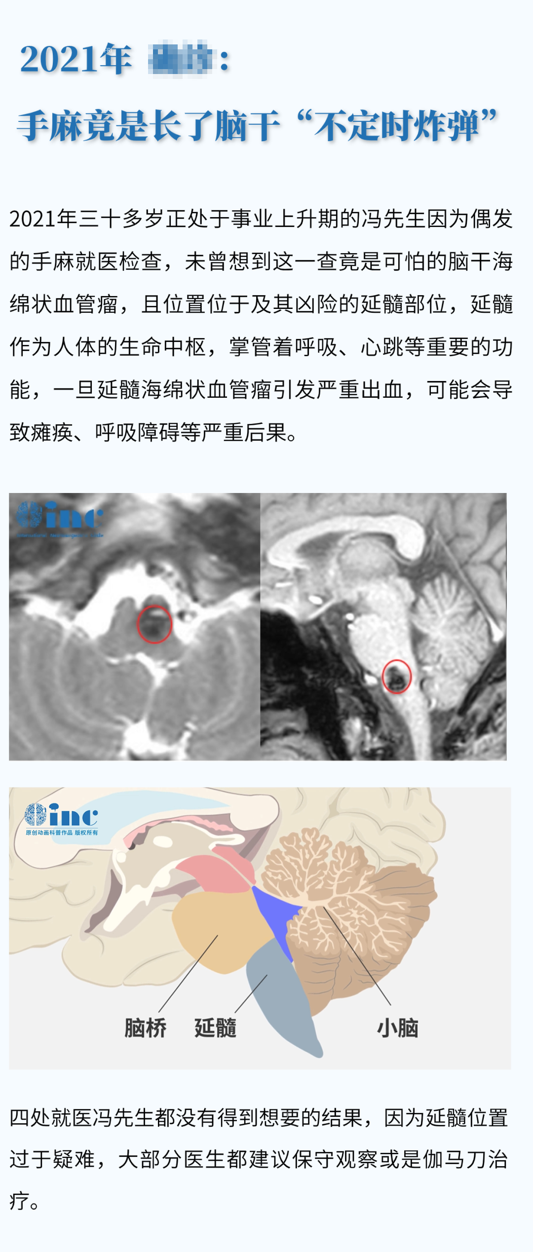 32歲腦干-延髓海綿狀血管瘤患者