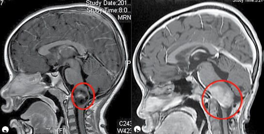 一名7歲兒童浸潤(rùn)性頸髓腫瘤的矢狀面造影后t1加權(quán)MRI(a)
