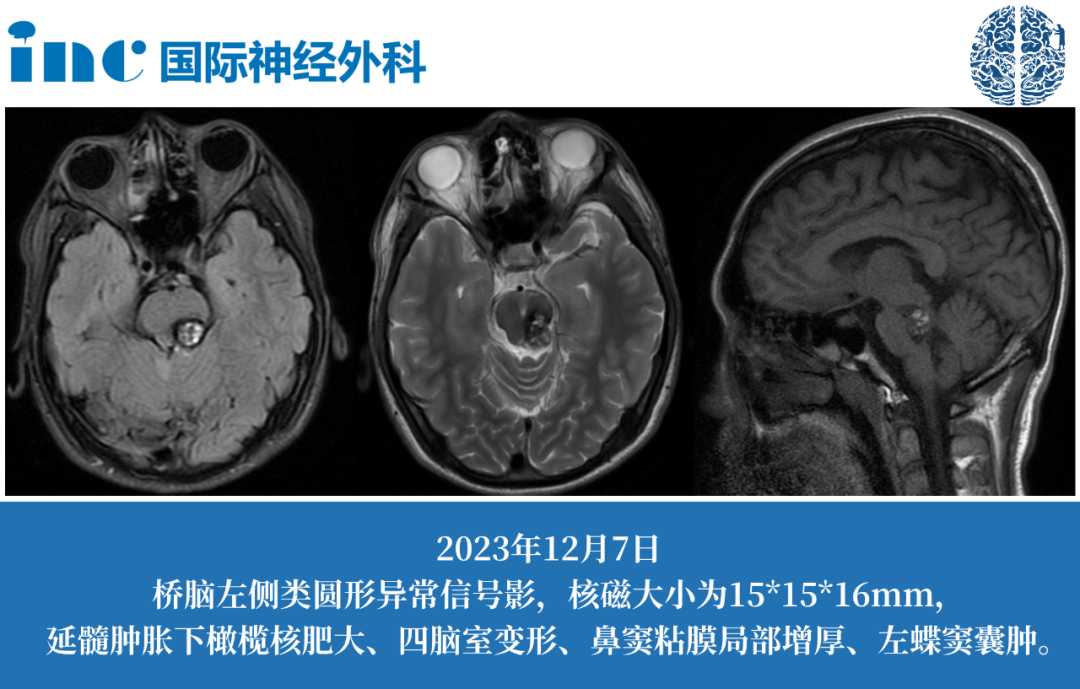16歲男孩腦干海綿狀血管瘤伴HOD