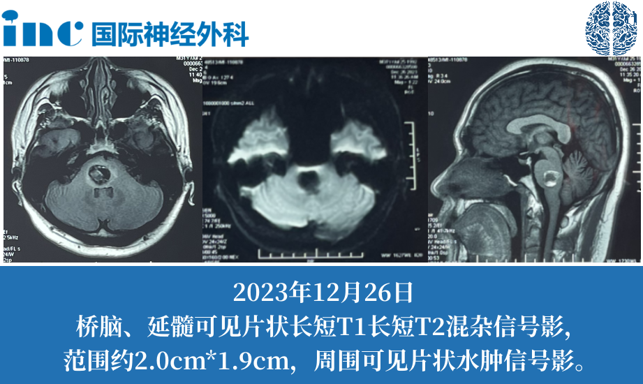31歲男性腦干海綿狀血管瘤致全身麻木