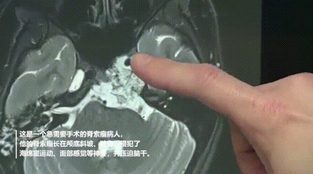 復雜脊索瘤長在斜坡、鞍區(qū)、侵犯海綿竇，福教授會如何做手術決策？