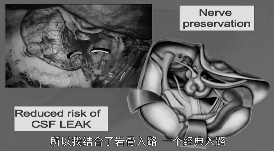 高MBI肥胖患者硬膜內脊索瘤，福教授右神經內鏡”筷子技術“順利全切