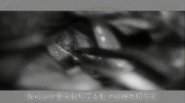 可以從基底肌和穿支肌上很好地切除它，切除是完全的，在顯微鏡下閉合。