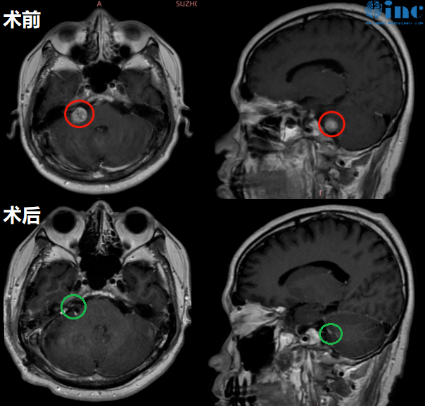 聽神經(jīng)瘤真實案例