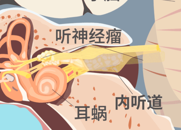 突發(fā)耳聾耳鳴也要警惕聽神經(jīng)瘤